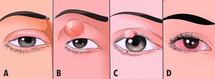 rosácea ocular, rosacea en los ojos, blefaritis, chalazión, orzuelos, conjuntivitis, ardor en los ojos