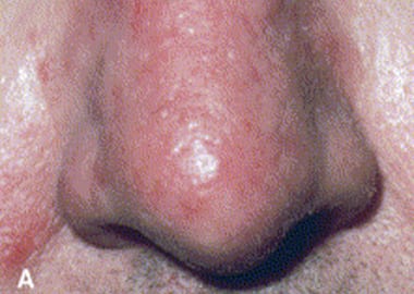 rinofima leve, rosacea fimatosa, nariz roja, rinofima, rosacea en la nariz, rosacea fimatosa tratamiento, tratamiento para la rinofima