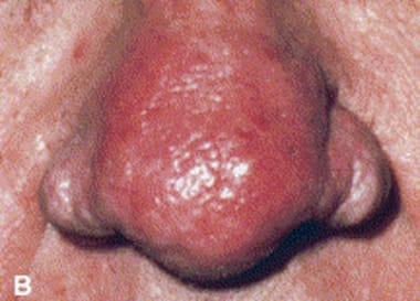 rinofima moderada, rosacea fimatosa, nariz roja, rinofima, rosacea en la nariz, rosacea fimatosa tratamiento, tratamiento para la rinofima